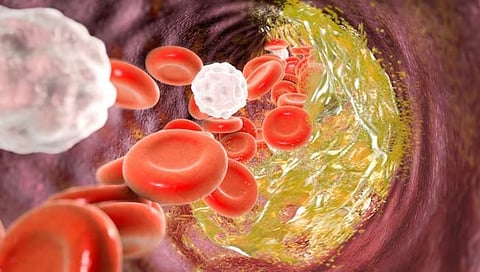Cholesterol : हृदय तंदुरुस्त ठेवण्यासाठी ‘हे’ ४ उपाय करा, कोलेस्ट्रॉल राहील नियंत्रणात