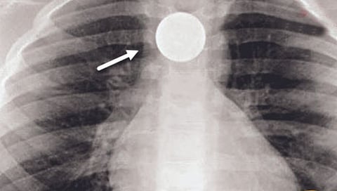 आठव्या वर्षी घशात अडकले नाणे, तेरा वर्षांनी काढले!