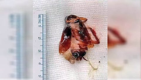 फुफ्फुसातून काढले चार सेंटिमीटरचे झुरळ