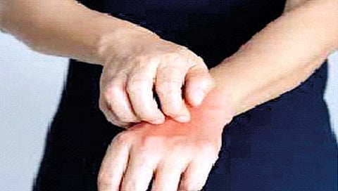 दीर्घकाळच्या खरुजावर ‘हे’ आहेत आयुर्वेदोपचार