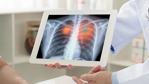 Covid Hit Lung Damage: