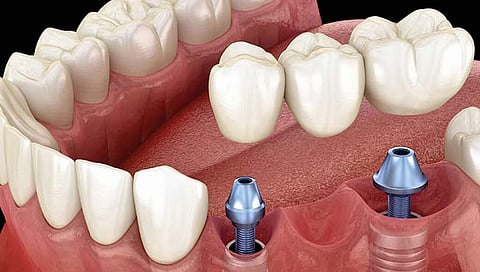 Dental implants