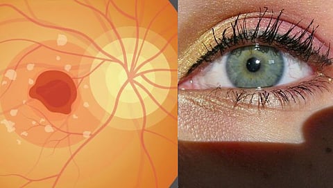 Macular Edema : मॅक्युलर एडिमा म्हणजे डोळ्याच्या रेटिनाला येणारी सूज; घ्यावयाची काळजी, लक्षणे अन् उपचार