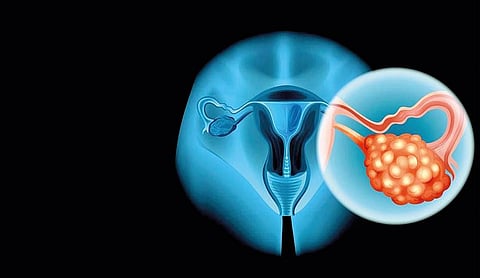 ovarian cancer