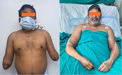 वैद्यकीय चमत्कार | अपंग पेंटरला मिळाले २ हात; दिल्लीत हातांचे प्रत्यारोपण यशस्वी