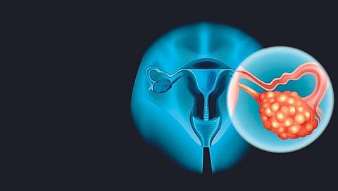 लक्षणे अंडाशयाच्या कर्करोगाची