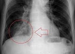 फुप्फुसामध्ये अडकला हळकुंडाचा तुकडा; पुढे काय झालं?