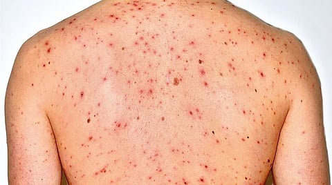 अत्यंत त्रासदायक कांजिण्यांचा फैलाव कसा होतो?