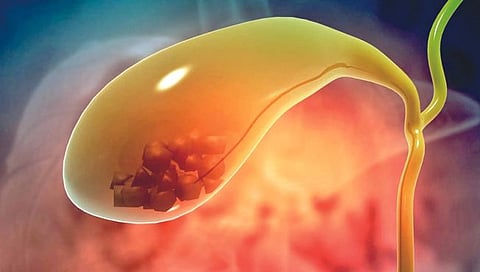 पित्ताशयात खडे कशामुळे होतात? जाणून घ्या अधिक