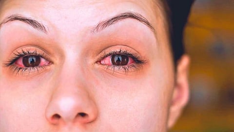 पावसाळ्यात घ्या डोळ्यांची काळजी, ‘या’ संसर्गाचा धोका