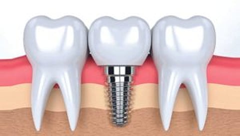 ‘कॉर्टिकल डेंटल इम्प्लांट’ म्हणजे काय?