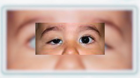 The problem is paralysis of the eyelids