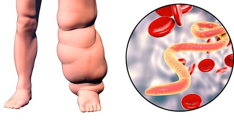 elephantiasis cases in Maharashtra