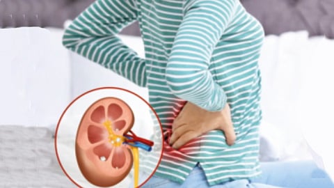 If you have kidney stones, you should avoid these foods