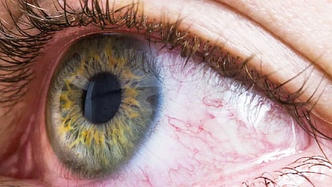 Hypertensive retinopathy