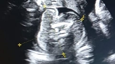 Fetus in the womb of a 9-month-old fetus