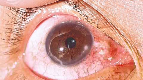 Eye infection