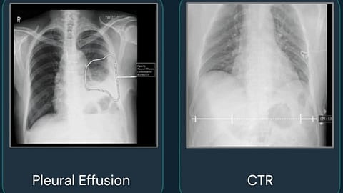 AI च्या मदतीने गडचिरोलीत झाले ८८ टीबी रुग्णांचे निदान