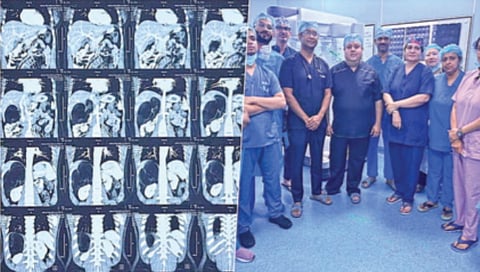 robotic-surgery-removes-football-sized-tumor-from-woman