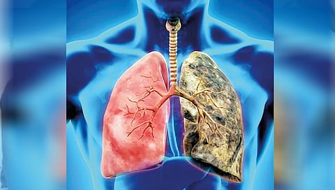inside-black-lung-disease-causes-symptoms-treatment