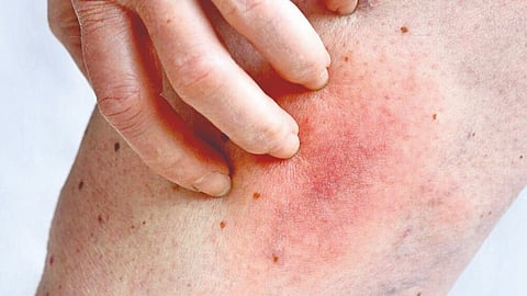 World Allergy Prevention Day Special