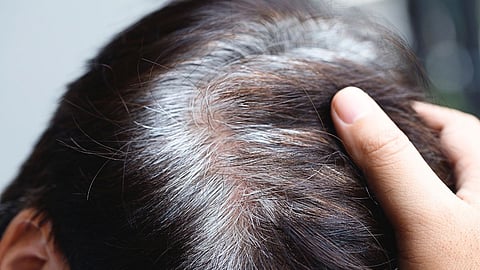White Hair In Children