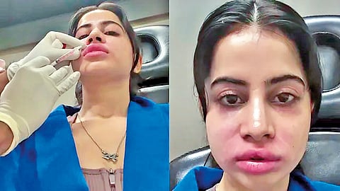 lip-fillers-benefits-and-risks