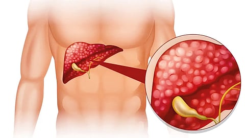 Fatty liver and liver cancer