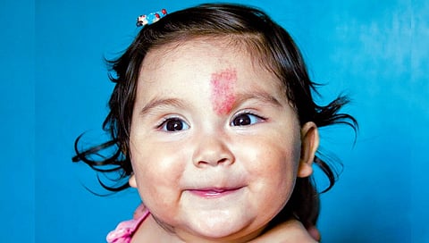 birthmarks-on-newborn-baby-skin