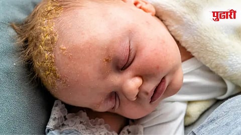 Baby Fungal Infection