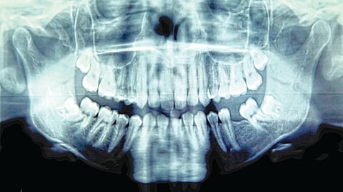 A rare and successful surgery on 34-year-old Brent Chapman from Canada