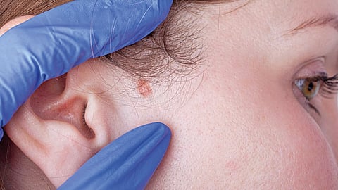 what-is-mohs-surgery-for-skin-cancer