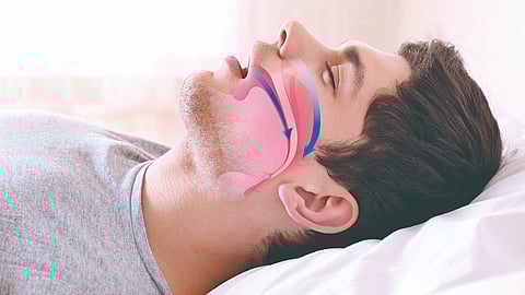 Sleep apnea stroke risk