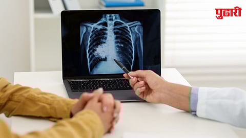 Tuberculosis Screening