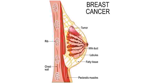 meat consumption, lack of sleep breast cancer risk