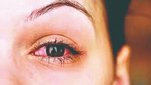 Eye infection