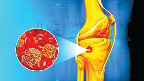 Bone Cancer Treatment