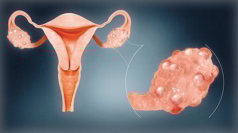 Polycystic Ovary Syndrome | पीसीओएसकडे दुर्लक्ष टाळा