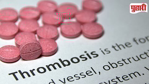 Thrombolysis