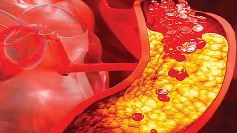 Heart attack prevention new drug |