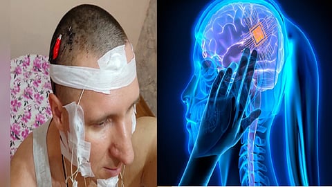 Russia- brain surgery- chip- dream control