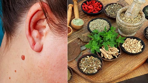 சித்தமருத்துவம் நோக்கில் மரு என்பது