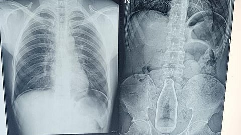 வயிற்றுக்குள் இருந்த பாட்டில்