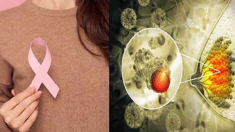 மார்பக புற்றுநோய்