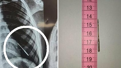 சிறுவனின் நுரையீரலில் இருந்து நீக்கப்பட்ட ஊசி