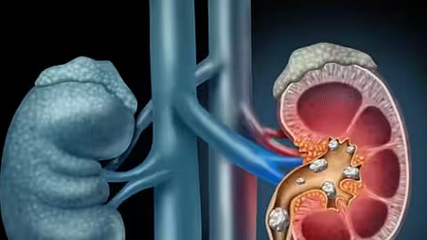 சிறுநீரக கல்