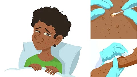 குரங்கு அம்மை