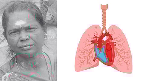 உடல் உறுப்பு தானம் செய்த சாந்தி