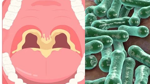 டிப்தீரியா