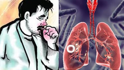 காசநோய்